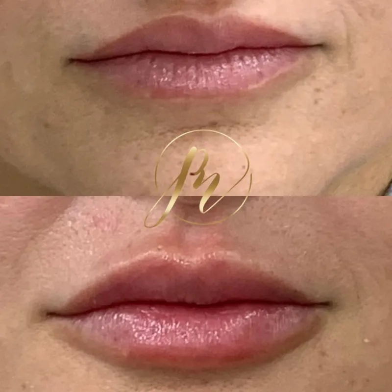 Preenchimento Labial