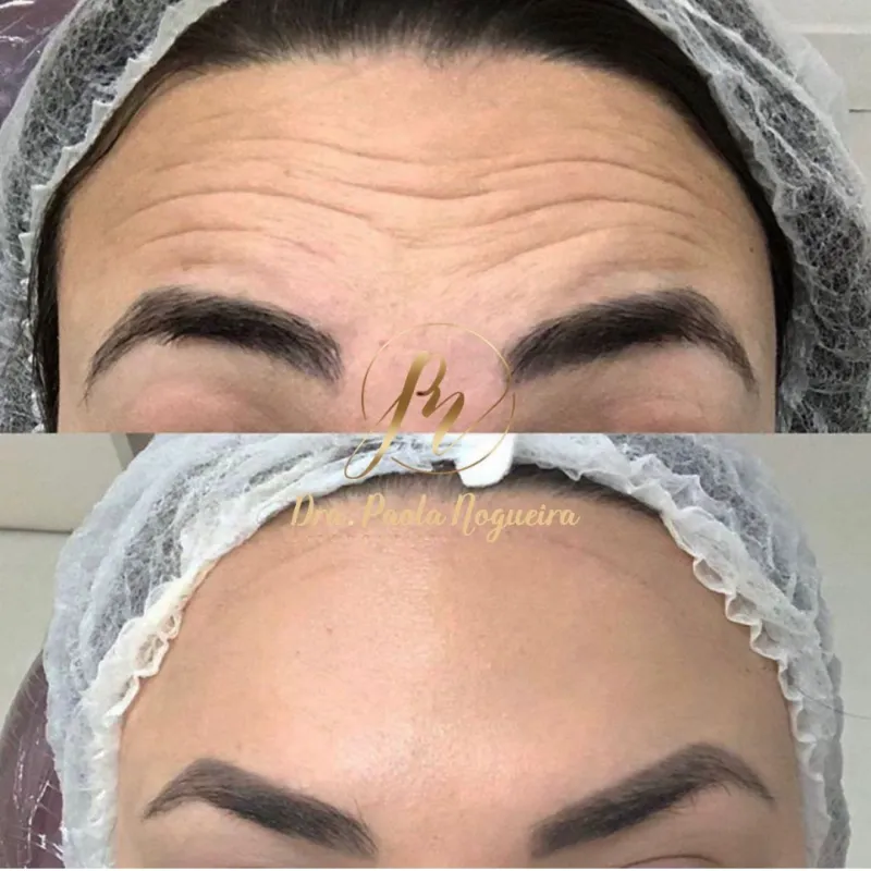 Toxina Botulínica