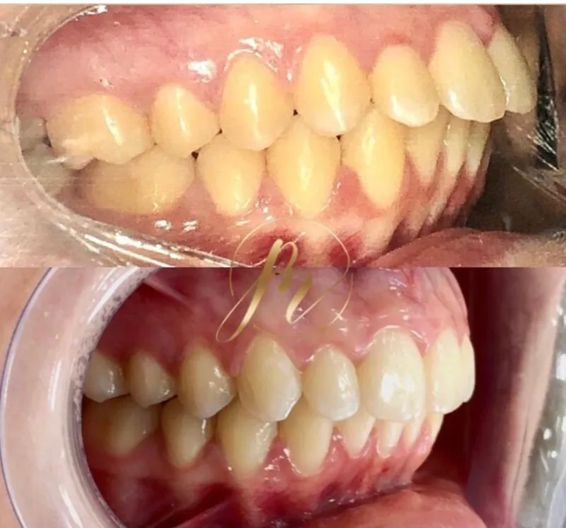 Tratamento com alinhador invisível: antes e depois