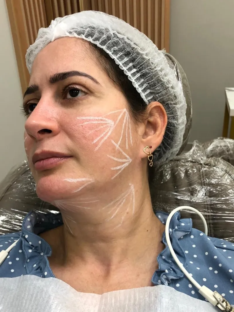 Atendimento de rejuvenescimento facial
