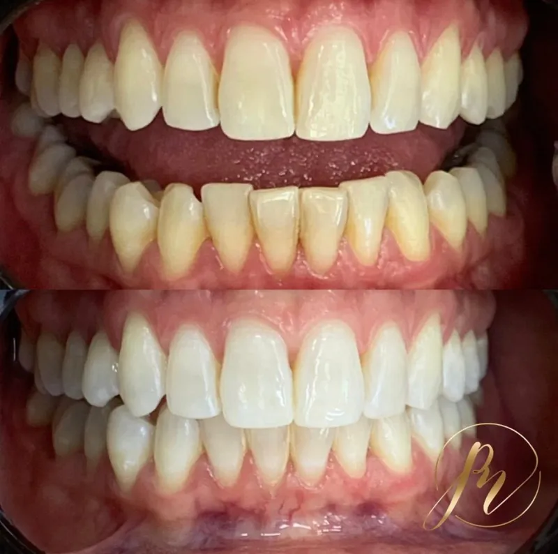 Clareamento dental: antes e depois