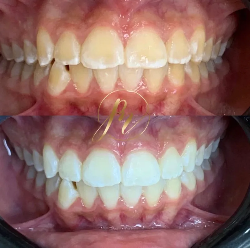 Resultado de clareamento dental: antes e depois