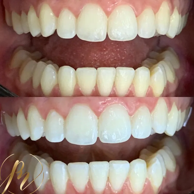 Sorriso após clareamento dental