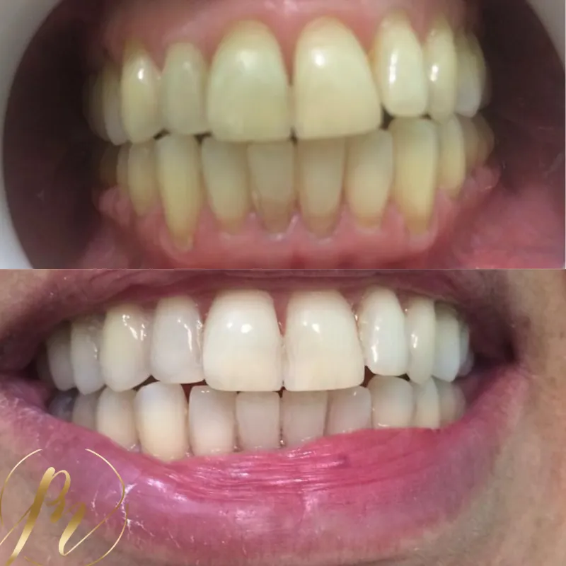 Clareamento dental com resultado natural