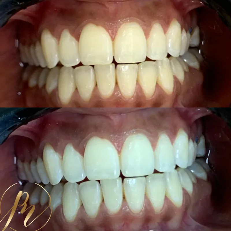 Comparativo de clareamento dental