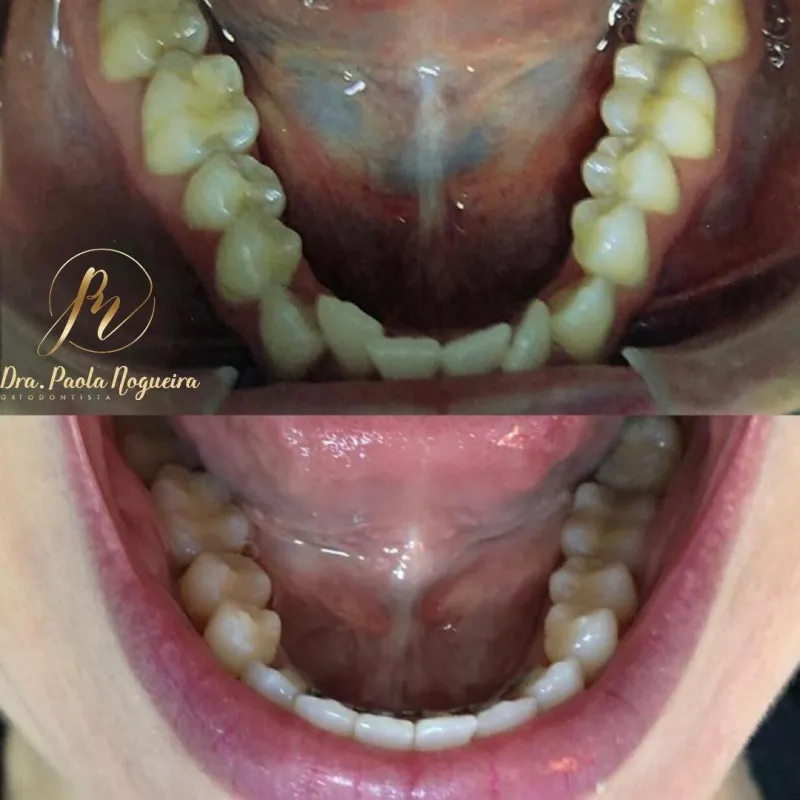 Resultado de tratamento ortodôntico: antes e depois