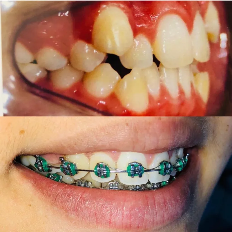 Correção ortodôntica do sorriso: antes e depois