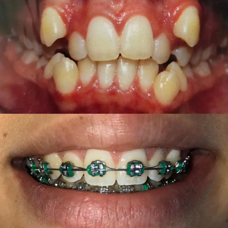 Alinhamento dentário: antes e depois