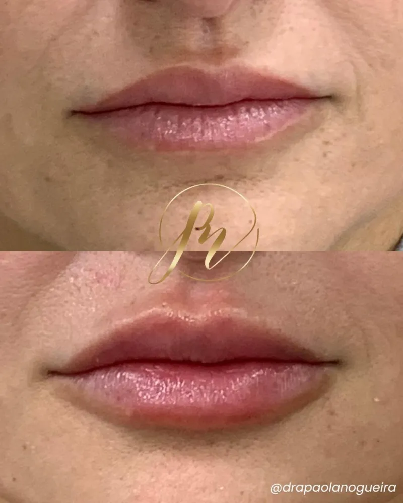 Antes e depois de preenchimento labial