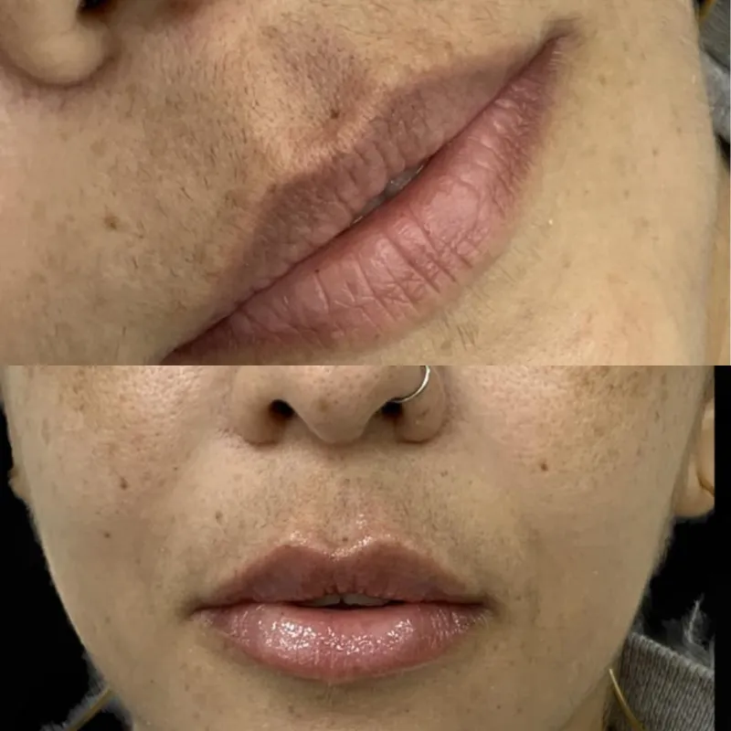 Resultado de preenchimento labial com ácido hialurônico