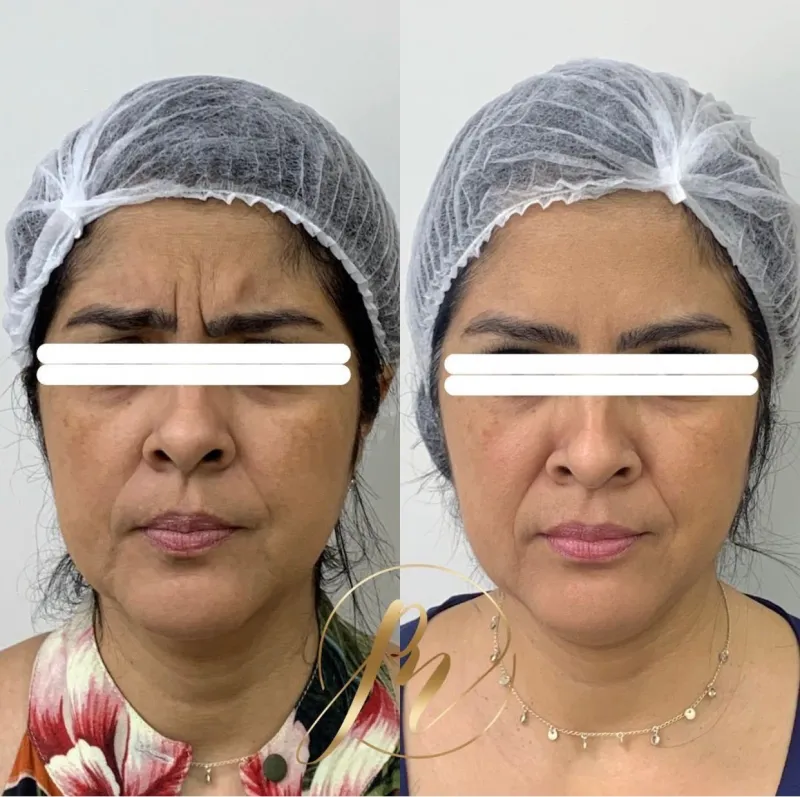 Resultado natural de toxina botulínica