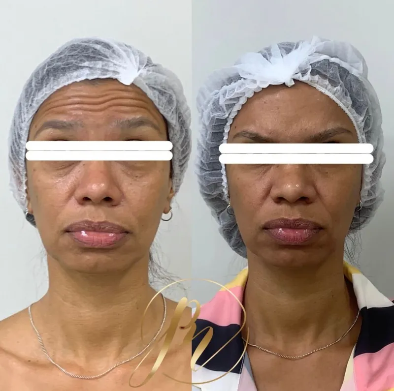 Antes e depois de toxina botulínica